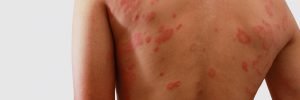 Eczema Laser Treatment, Causes, Risk, and Side Effects