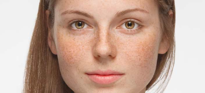 Hyperpigmentation, Laser and Chemical Peel Therapy