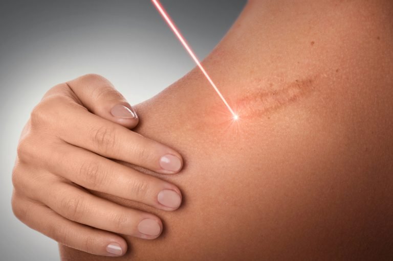 Scar Removal In Delhi, Process, Guidelines, Recovery, Result