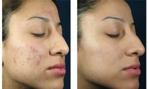 A chemical peel treatment, Benefits, Result, Candidate