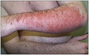 What Is Dermatitis? Symptoms, Treatment, and Prevention