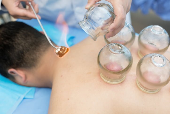 Cupping Therapy In Delhi, Procedure, Pros, and Cons |