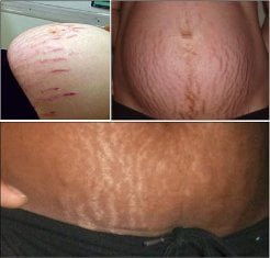 Stretch Marks removal in Delhi, Results, Recovery, and The cost
