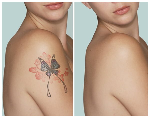 Tattoo Removal Question And Answer