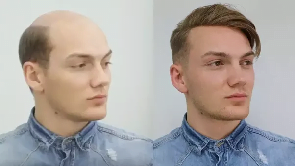 Hair Transplant Treatment Questions and Answers | Hair Transplant Treatment Questions and Answers |