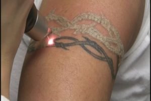 Tattoo Removal Question And Answer