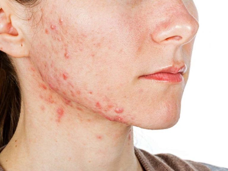 Acne Removal Question And Answer, FAQ