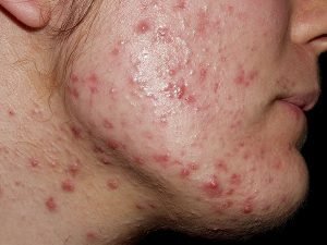 Acne Removal Delhi