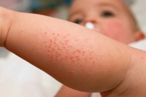 Eczema