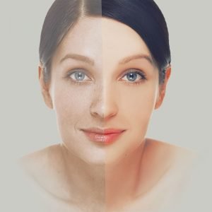 Laser Resurfacing Treatment Question and Answer