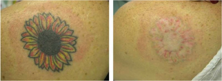 Tattoo Removal Recovery, Tips for Better Result