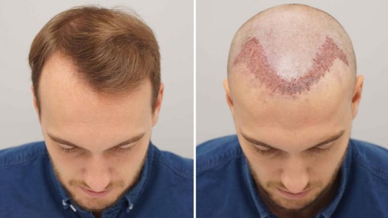 Hair Transplant Question and Answer
