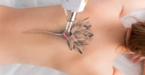  Laser Tattoo Removal, Get the Answer of most asked Questions
