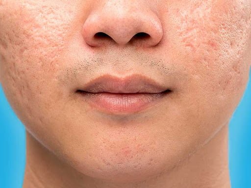 Large Pores Causes, Treatment, Cost and Result