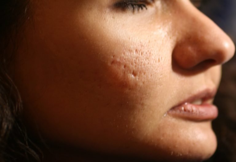 Acne Scar Laser Treatment and Types