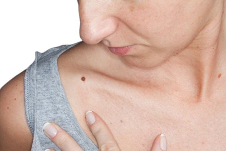 Moles Removal Causes and Best Treatment Options