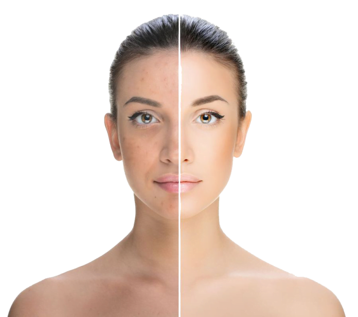 Face Whitening Treatment Cost Face Whitening Treatment in Delhi